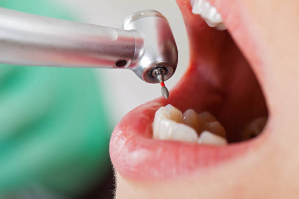 Best Emergency Dental Filling Replacement  in Vandalia, MO